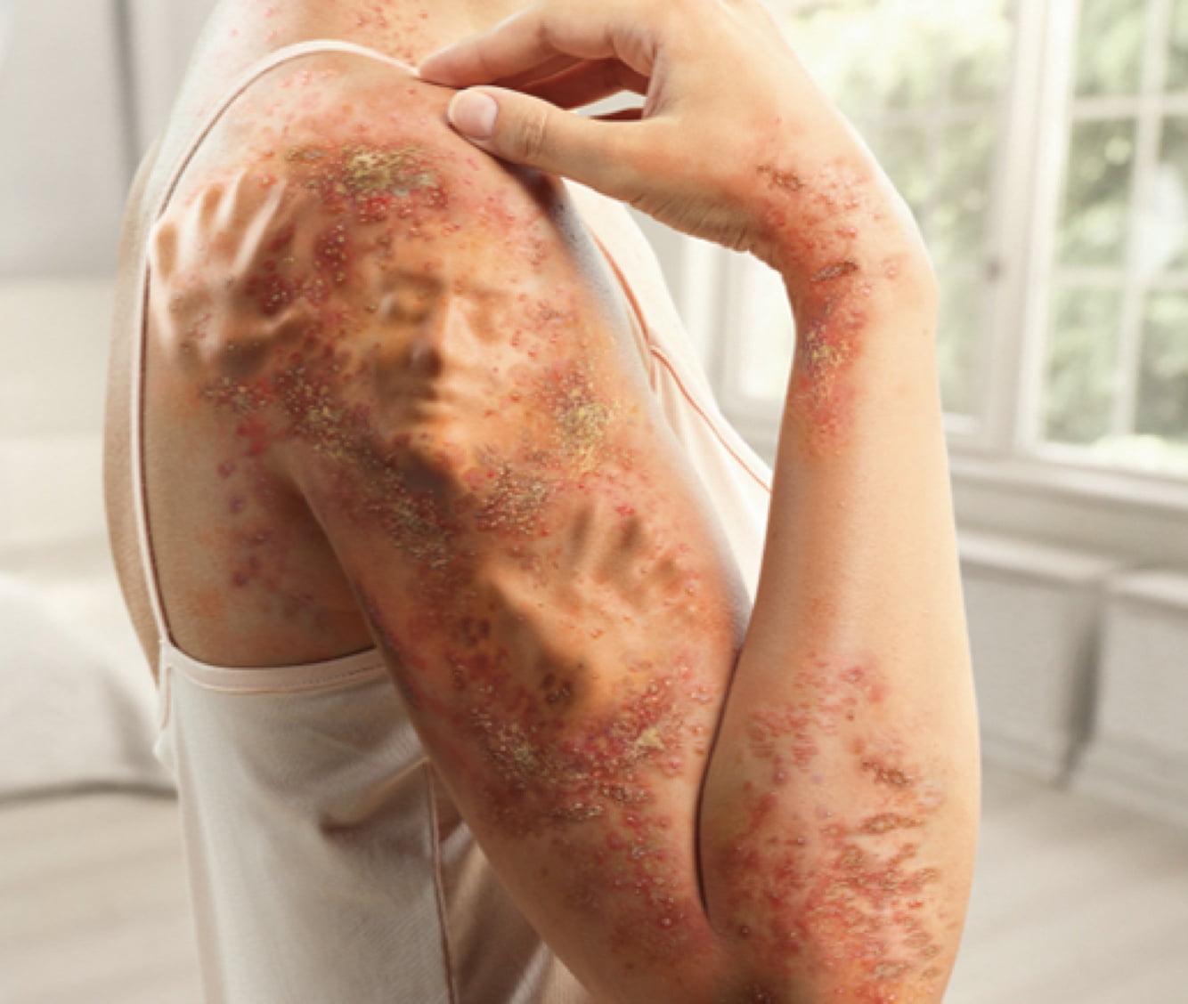 Woman with GPP rash that looks as if someone is trapped in it